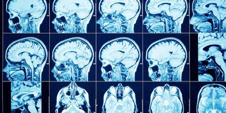Российские ученые разработали новый более точный метод МРТ головного мозга